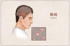 預防癲癇病發作的護理措施